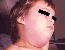 Image of child with Mumps